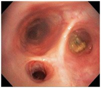 Abnormal Bronchoscopy: View of the airways/bronchi with mucous and inflammation
